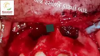 A CASE OF ORAL SURGERY (CYST ) DONE @dhavujani1 #dentalcare #bestdentist #dental