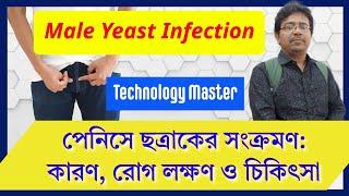 Male Yeast Infection: Symptoms and Treatment পেনিসে ছত্রাকের সংক্রমণ: কারণ, রোগ লক্ষণ ও চিকিৎসা