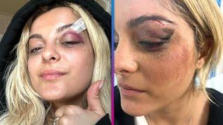 Bebe Rexha Fan Hit Singer With Phone, Thinking 'It Would Be Funny’