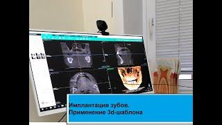 Имплантация зубов. 3d-шаблон в имплантации зубов. Клиника "Имплант-Сибирь"