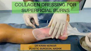 Collagen Dressing in first degree burns | Dr Kiran Nerkar | Plastic Surgeon Nashik