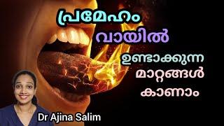 Oral Changes in Diabetes | Oral manifestation of Diabetes | Dr Ajina Salim