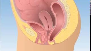 Пролапс мочевого пузыря (цистоцеле)