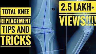 Total Knee Replacement (Step by Step Guide for Beginners)