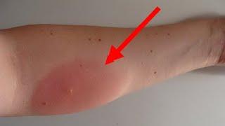 Чем снять отек от укуса комара или мошки.  Что делать после укуса насекомого