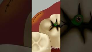 ASMR Molar Tooth Caries Removal so Satisfying || Dental Care Animation #shorts #ytshorts