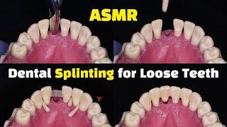 Dental Splinting for Loose Teeth using Ribbond after a Tooth Extraction