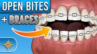 How Do Braces Fix Open Bites? | Premier Orthodontics