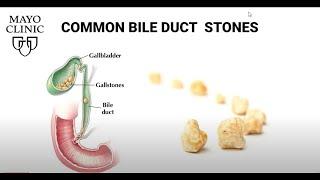 Laparoscopic Transcystic Common Bile Duct Exploration