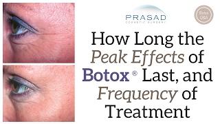 How Long Botox® can Last, and Why Lack of Movement Doesn't Make it Last Longer