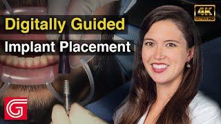 Digitally Guided #ImplantPlacement