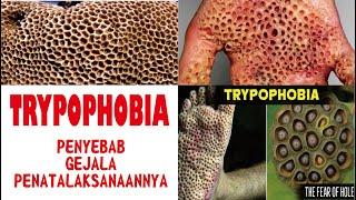 TRYPOPHOBIA............... PENYEBAB, GEJALA DAN PENATALAKSANAANYA