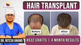  Hair Transplant Journey: 4532 Grafts with 4 Month Results | Head cleaning after hair transplant