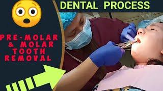 NAGPABUNOT AKO NG IPIN  |Dental Removal Process