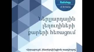 Ներլյարդային լեղուղիների քարերի հեռացում առանց վիրահատության