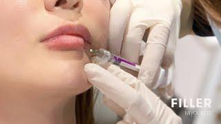 Cosmetic Injectables: dermal fillers creating natural volumised look