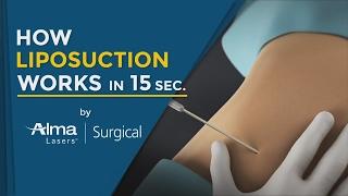How Liposuction Works in 15 Seconds (Medical Technology 3D Animation 2020)