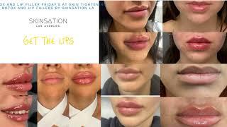 Forma Facial at Skin Tightening, Botox and Lip Fillers by Skinsation LA