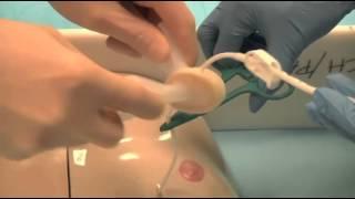 Tunneled Central Venous Catheters: Maintenance and Management