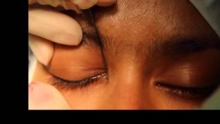 Lacrimal probing and syringing
