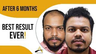 Hair Transplant ( 3280 grafts) - 6 months result by  @alloroots