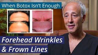 Treating Forehead Wrinkles [ How to get rid of #Stubborn #ForeheadLines when #Botox isn't Enough]