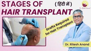 Best Stage To Get  Hair Transplantation Done | FUT vs FUE Techniques | Numbers of Grafts Required