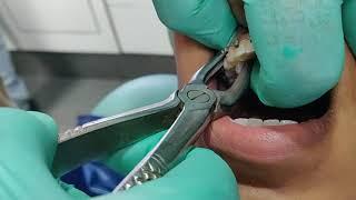 Painless and Easiest method for tooth extraction