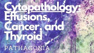 Cytopathology Cases: Pleural Effusion, Lung Adenocarcinoma, Melanoma, Thyroid #pathagonia