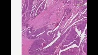 Histopathology Kidney--Transitional cell carcinoma