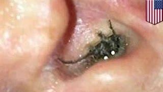 Видео с пауком в ухе оказалось розыгрышем