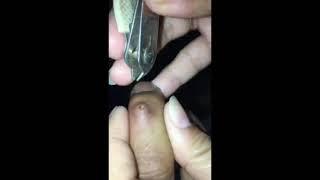 Satisfying HUGE splinter REMOVAL .. 3 weeks SPLINTER at my finger