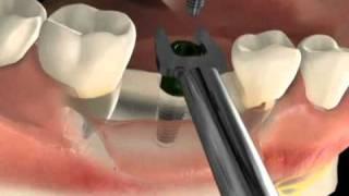Cirurgia de implante dentário - Vídeo da técnica - São Paulo SP