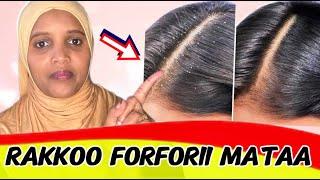 Rifeensa forforiin miidhamee fi furmaata hatattamaa/How to get rid of dandruff