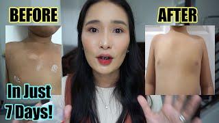 PHP 37.00 ONLY! AFFORDABLE & EFFECTIVE NA ANTIFUNGAL CREAM FOR RINGWORM | Galy Gascon