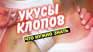 Почему клопы кусают не всех? Иммунитет, возраст и группа крови