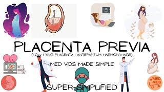 Placenta previa - Antepartum hemorrhage (Obstetrics & Gynecology) - Med Vids Made Simple