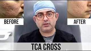 TCA Cross (Acne Scar Treatment) Before VS. After