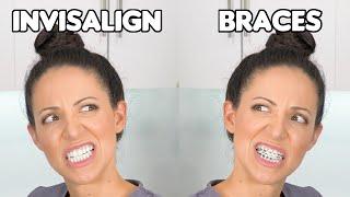 Braces or Invisalign? (Which is BETTER)