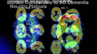 Redefining Alzheimer's Disease: New Diagnostic Criteria