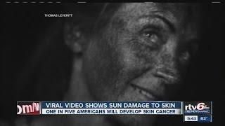Video: UV camera shows harsh realities of sun damage