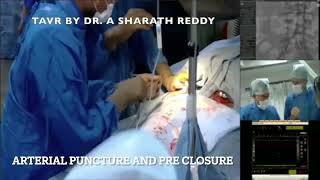 Live TAVR Procedure: Witness the Revolutionary Minimally Invasive Heart Surgery | Dr. Sharath Reddy