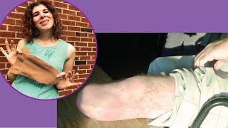 Residual Limb Shrinkers Post-Amputation