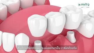 ฟันเทียมมีกี่ประเภท ทพ.พงศ์รพี กมลรุ่งวรากุล