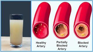 How to Clear Blockage in Heart without Surgery | Healthy Diets for the Heart