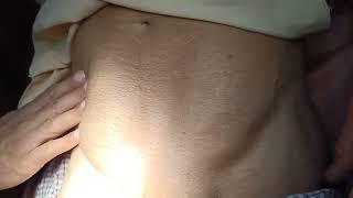 Morgagni Bulge In 80 Years Old  Male increases in size on lifting head it's not hernia