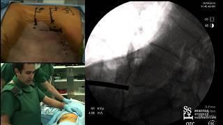 Lateral Transpsoas Approach to the Lumbar Spine - Noojan Kazemi, M.D.