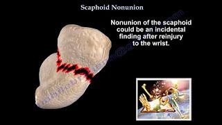 Scaphoid Nonunion  - Everything You Need To Know - Dr. Nabil Ebraheim