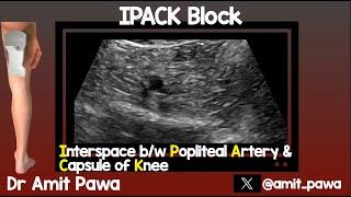 IPACK (Interspace between Popliteal Artery and Capsule of the Knee)