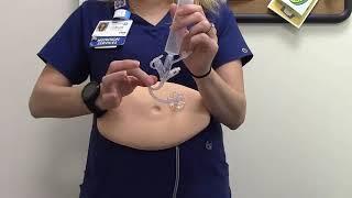 How to use a G-Tube | Moffitt Cancer Center